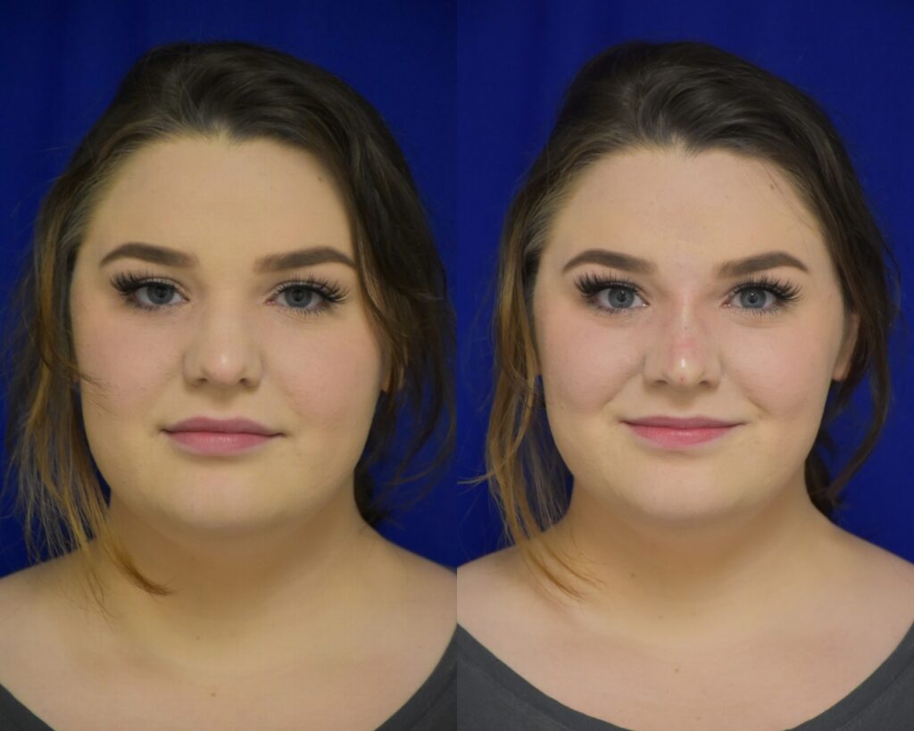 Liquid Rhinoplasty before and after photo by Dr. Sean Weiss in Metairie LA HB