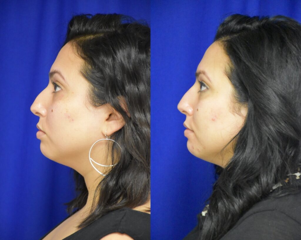 Nonsurgical Rhinoplasty before and after photo by Dr. Sean Weiss in Metairie LA