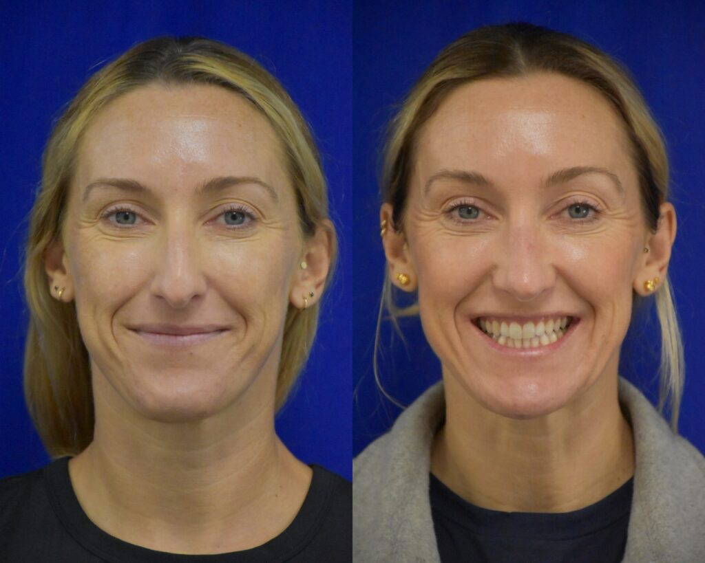 Rhinoplasty before and after photo by Dr. Sean Weiss in Metairie LA