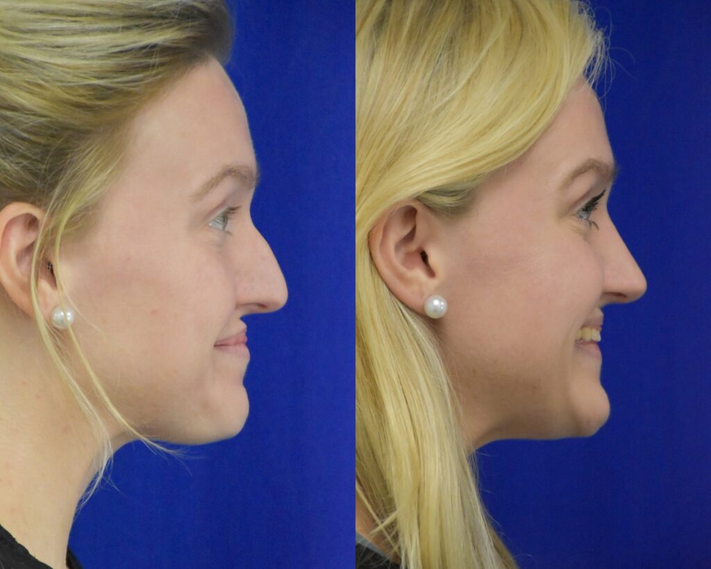 Rhinoplasty before and after photo by Dr. Sean Weiss in Metairie LA