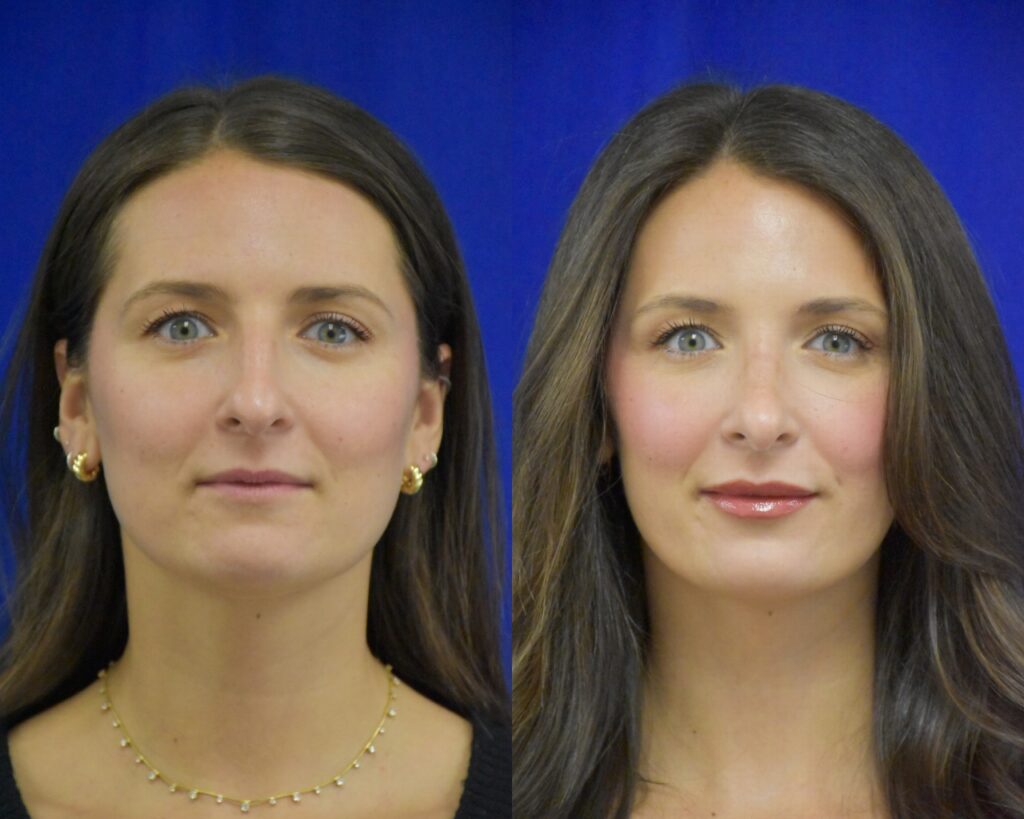Rhinoplasty before and after photo by Dr. Sean Weiss in Metairie LA