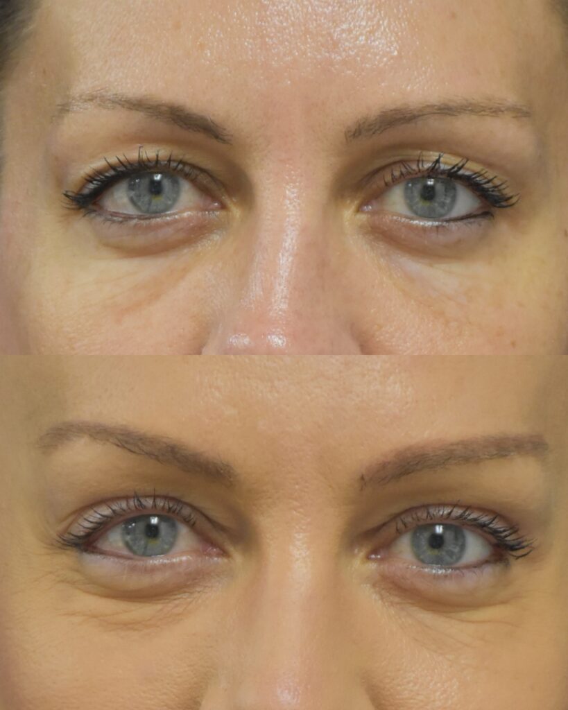 Upper Blepharoplasty before and after photo by Dr. Sean Weiss in Metairie LA